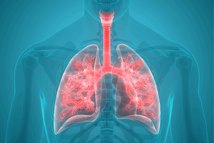 managedermatomyositis.com, interstitial-lung-disease