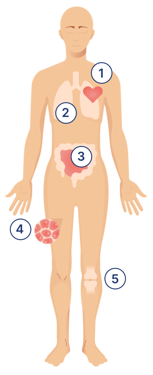 managedermatomyositis.com, body-different-complications-illustration