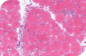 managedermatomyositis.com, close-up-muscle-scientific-image6