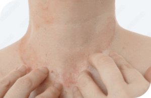 managedermatomyositis.com, hands-touching-breakout-on-neck-area